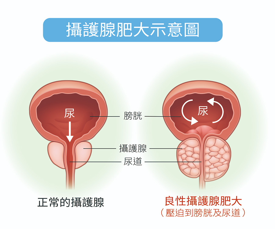 攝護腺肥大.jpg